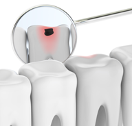 虫歯の原因 – プラーク・細菌以外の生活に潜むリスク
