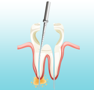 根管治療 - 治療の流れと症状・痛み