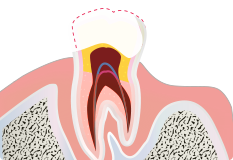 歯髄を除去 イラスト