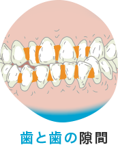 歯と歯の隙間