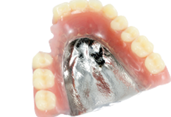 金属床義歯 写真