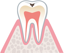 軽度の虫歯 イラスト