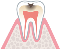 中度の虫歯　イラスト