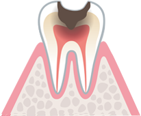 重度の虫歯　イラスト