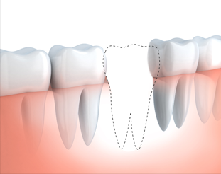 歯を1本失った場合の治療法 イラスト