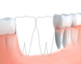 歯を数本失った場合の治療法 イラスト