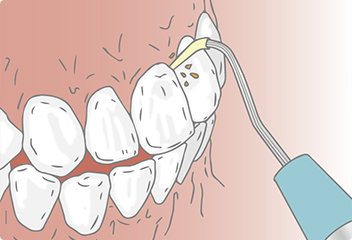 歯石除去のイラスト