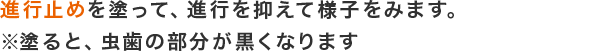 進行止め（サホライド）を塗って、進行を抑えて様子をみます。※サホライドを塗ると、虫歯の部分が黒くなります